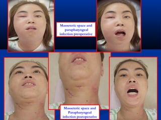 Masseteric space and
parapharyngeal
infection preoperative
Masseteric space and
Parapharyngeal
infection postoperative
 