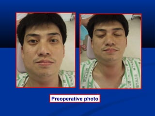 Preoperative photo
 