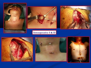 Intraoperative I & D
 