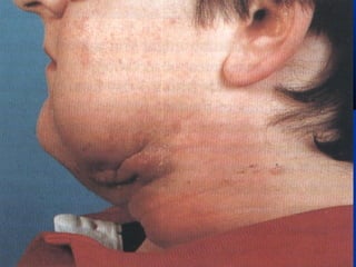 Actinomycosis
 Mainly caused by A. Israeli (anaerobic) andMainly caused by A. Israeli (anaerobic) and
affects lower jawaffects lower jaw
 Implantation of the bacteria in the tissue afterImplantation of the bacteria in the tissue after
extraction or facial traumaextraction or facial trauma
 Manifested either as a tumour like mass in theManifested either as a tumour like mass in the
soft tissue or an oozing sinuses overlying thesoft tissue or an oozing sinuses overlying the
angle of the mandibleangle of the mandible
 Hospitalization for a week and high doses ofHospitalization for a week and high doses of
antibiotic, then continue with penicillin for atantibiotic, then continue with penicillin for at
least 3 months.least 3 months.
 Tetracycline or doxycycline are second choices.Tetracycline or doxycycline are second choices.
 