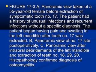  FIGURE 17-3 A, Panoramic view taken of aFIGURE 17-3 A, Panoramic view taken of a
55-year-old female before extraction of55-year-old female before extraction of
symptomatic tooth no. 17. The patient hadsymptomatic tooth no. 17. The patient had
a history of unusual infections and recurrenta history of unusual infections and recurrent
infections without a specific diagnosis. Theinfections without a specific diagnosis. The
patient began having pain and swelling inpatient began having pain and swelling in
the left mandible after tooth no. 17 wasthe left mandible after tooth no. 17 was
extracted. B, Panoramic view of no. 17 siteextracted. B, Panoramic view of no. 17 site
postoperatively. C, Panoramic view afterpostoperatively. C, Panoramic view after
intraoral débridements of the left mandibleintraoral débridements of the left mandible
and extraction of teeth no. 18, 29, 20.and extraction of teeth no. 18, 29, 20.
Histopathology confirmed diagnosis ofHistopathology confirmed diagnosis of
osteomyelitis.osteomyelitis.
 