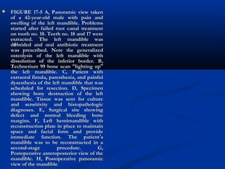  FIGURE 17-5 A, Panoramic view takenFIGURE 17-5 A, Panoramic view taken
of a 42-year-old male with pain andof a 42-year-old male with pain and
swelling of the left mandible. Problemsswelling of the left mandible. Problems
started after failed root canal treatmentstarted after failed root canal treatment
on tooth no. 18. Teeth no. 18 and 17 wereon tooth no. 18. Teeth no. 18 and 17 were
extracted. The left mandible wasextracted. The left mandible was
ddéébrided and oral antibiotic treatmentbrided and oral antibiotic treatment
was prescribed. Note the generalizedwas prescribed. Note the generalized
osteolysis of the left mandible withosteolysis of the left mandible with
dissolution of the inferior border. B,dissolution of the inferior border. B,
Technetium 99 bone scanTechnetium 99 bone scan ““lighting uplighting up””
the left mandible. C, Patient withthe left mandible. C, Patient with
extraoral fistula, paresthesia, and painfulextraoral fistula, paresthesia, and painful
dysesthesia of the left mandible that wasdysesthesia of the left mandible that was
scheduled for resection. D, Specimenscheduled for resection. D, Specimen
showing bony destruction of the leftshowing bony destruction of the left
mandible. Tissue was sent for culturemandible. Tissue was sent for culture
and sensitivity and histopathologicand sensitivity and histopathologic
diagnoses. E, Surgical site showingdiagnoses. E, Surgical site showing
defect and normal bleeding bonedefect and normal bleeding bone
margins. F, Left hemimandible withmargins. F, Left hemimandible with
reconstruction plate in place to maintainreconstruction plate in place to maintain
space and facial form and providespace and facial form and provide
immediate function. The patientimmediate function. The patient’’ss
mandible was to be reconstructed in amandible was to be reconstructed in a
second-stage procedure. G,second-stage procedure. G,
Postoperative anteroposterior view of thePostoperative anteroposterior view of the
mandible. H, Postoperative panoramicmandible. H, Postoperative panoramic
view of the mandibleview of the mandible..
 