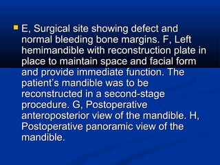  E, Surgical site showing defect andE, Surgical site showing defect and
normal bleeding bone margins. F, Leftnormal bleeding bone margins. F, Left
hemimandible with reconstruction plate inhemimandible with reconstruction plate in
place to maintain space and facial formplace to maintain space and facial form
and provide immediate function. Theand provide immediate function. The
patient’s mandible was to bepatient’s mandible was to be
reconstructed in a second-stagereconstructed in a second-stage
procedure. G, Postoperativeprocedure. G, Postoperative
anteroposterior view of the mandible. H,anteroposterior view of the mandible. H,
Postoperative panoramic view of thePostoperative panoramic view of the
mandible.mandible.
 