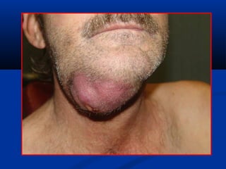 Odontogenic Infection