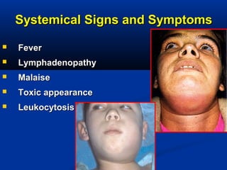 Systemical Signs and SymptomsSystemical Signs and Symptoms
 FeverFever
 LymphadenopathyLymphadenopathy
 MalaiseMalaise
 Toxic appearanceToxic appearance
 LeukocytosisLeukocytosis
 