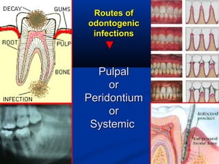 Routes ofRoutes of
odontogenicodontogenic
infectionsinfections
▼▼
PulpalPulpal
oror
PeridontiumPeridontium
oror
SystemicSystemic
 