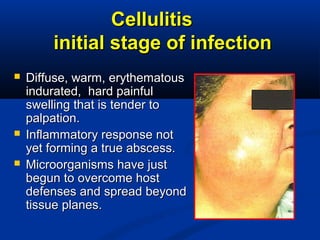 CellulitisCellulitis
initial stage of infectioninitial stage of infection
 Diffuse, warm, erythematousDiffuse, warm, erythematous
indurated, hard painfulindurated, hard painful
swelling that is tender toswelling that is tender to
palpation.palpation.
 Inflammatory response notInflammatory response not
yet forming a true abscess.yet forming a true abscess.
 Microorganisms have justMicroorganisms have just
begun to overcome hostbegun to overcome host
defenses and spread beyonddefenses and spread beyond
tissue planes.tissue planes.
 