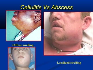 Cellulitis Vs AbscessCellulitis Vs Abscess
Diffuse swelling
Localized swelling
 