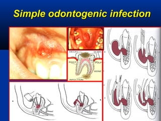 Simple odontogenic infectionSimple odontogenic infection
 