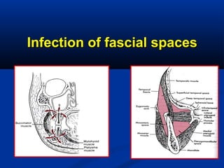 Infection of fascial spacesInfection of fascial spaces
 