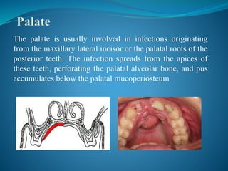 Palatal Infection Odontogenic Infection | PPTX