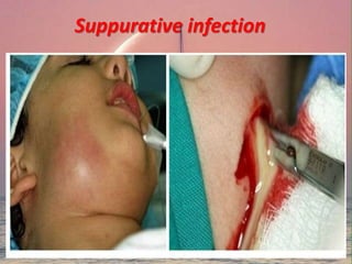 Suppurative infection
 