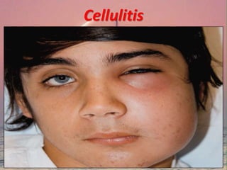 Cellulitis
 