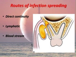 Routes of infection spreading
• Direct continuity
• Lymphatic
• Blood stream
 