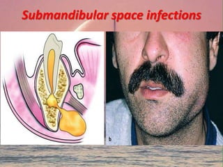 Submandibular space infections
 