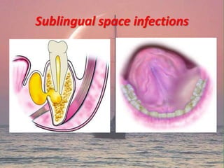 Sublingual space infections
 