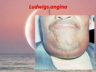 Ludwigs angina
 