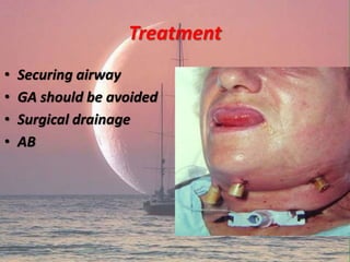 Treatment
• Securing airway
• GA should be avoided
• Surgical drainage
• AB
 
