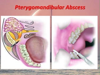 Pterygomandibular Abscess
 