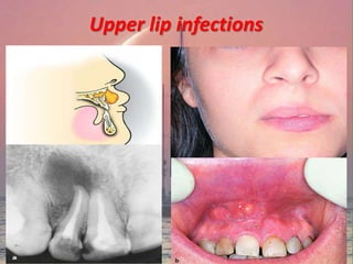 Upper lip infections
 