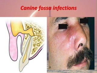 Canine fossa infections
 