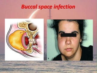 Buccal space infection
 