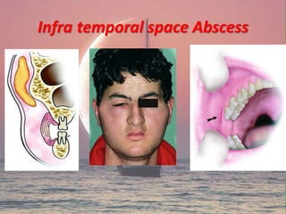 Infra temporal space Abscess
 