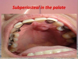Subperiosteal in the palate
 