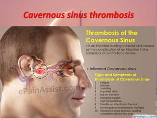 Cavernous sinus thrombosis
 
