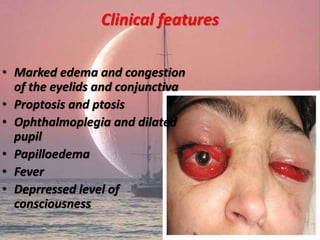 Clinical features
• Marked edema and congestion
of the eyelids and conjunctiva
• Proptosis and ptosis
• Ophthalmoplegia and dilated
pupil
• Papilloedema
• Fever
• Deprressed level of
consciousness
 