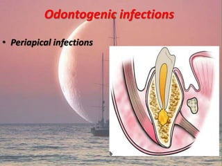 Odontogenic infections
• Periapical infections
 