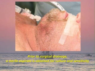 Prior to surgical drainage,
a sterile aspirate is obtained for culture and sensitivity
 