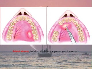 Palatal abscess , incision parallel to the greater palatine vessels
 