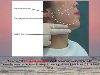 An incision at submandibular region should be placed two fingers’ breadth
below the lower border to avoid injury of the marginal mandibular branch of the facial
nerve
 