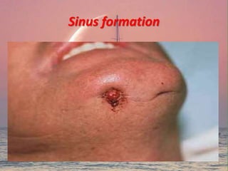 Sinus formation
 