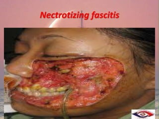 Nectrotizing fascitis
 