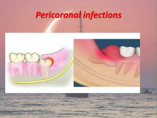 Pericoronal infections
 