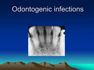 Odontogenic infections
 