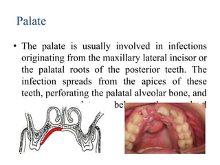 Palatal Infection odontogenicinfections-1 in dental surgery.pptx