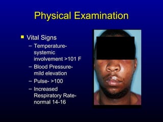 Physical Examination
   Vital Signs
    – Temperature-
      systemic
      involvement >101 F
    – Blood Pressure-
      mild elevation
    – Pulse- >100
    – Increased
      Respiratory Rate-
      normal 14-16
 