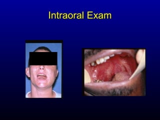 Intraoral Exam
 