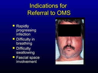 Indications for
          Referral to OMS
   Rapidly
    progressing
    infection
   Difficulty in
    breathing
   Difficulty
    swallowing
   Fascial space
    involvement
 