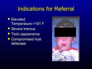 Indications for Referral
   Elevated
    Temperature >101 F
   Severe trismus
   Toxic appearance
   Compromised host
    defenses
 