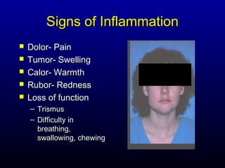 Signs of Inflammation
   Dolor- Pain
   Tumor- Swelling
   Calor- Warmth
   Rubor- Redness
   Loss of function
    – Trismus
    – Difficulty in
      breathing,
      swallowing, chewing
 