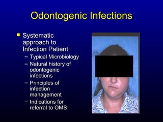 Odontogenic Infections
   Systematic
    approach to
    Infection Patient
    – Typical Microbiology
    – Natural history of
      odontogenic
      infections
    – Principles of
      infection
      management
    – Indications for
      referral to OMS
 