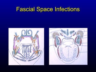 Fascial Space Infections
 