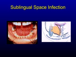 Sublingual Space Infection
 