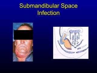 Submandibular Space
     Infection
 
