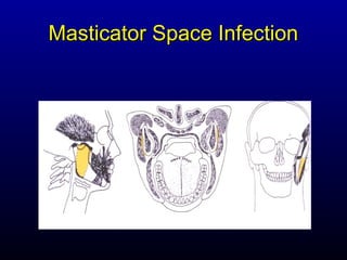 Masticator Space Infection
 
