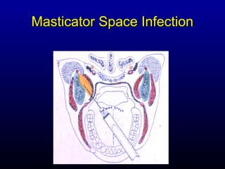 Masticator Space Infection
 